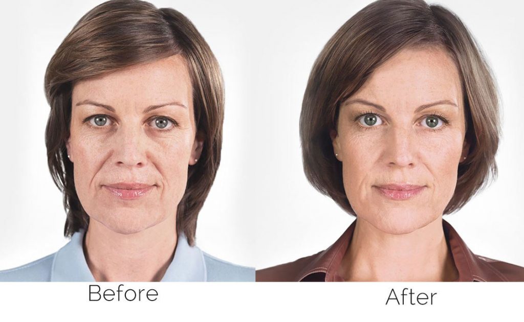 Sculptra Aesthetic Before and After