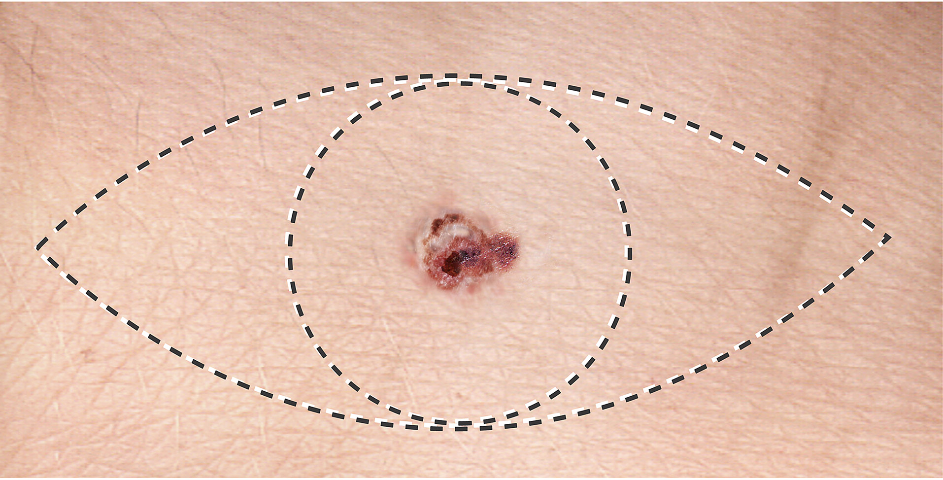 Surgical Dermatology - Philadelphia, PA - Dermatology