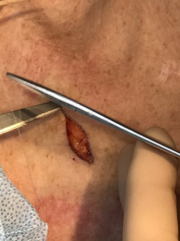 Surgical Dermatology Excision