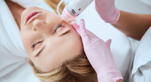 Model of patient receiving microneedling Treatments at Philly Skin and Laser in Philadelphia, PA